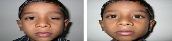 Eyelid Drooping (Ptosis)